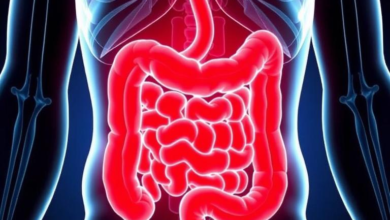 Colon Cancer