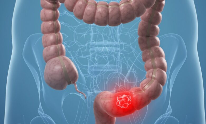 colon cancer